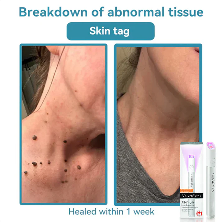 Oceahade™ All-in-One CO₂ Laser Eraser Pen | Removes Moles, Warts, Skin Flaws & Pigmentation