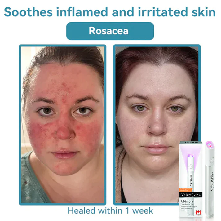 Oceahade™ All-in-One CO₂ Laser Eraser Pen | Removes Moles, Warts, Skin Flaws & Pigmentation