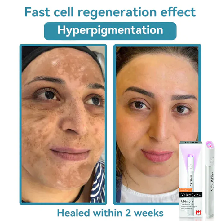 Oceahade™ All-in-One CO₂ Laser Eraser Pen | Removes Moles, Warts, Skin Flaws & Pigmentation