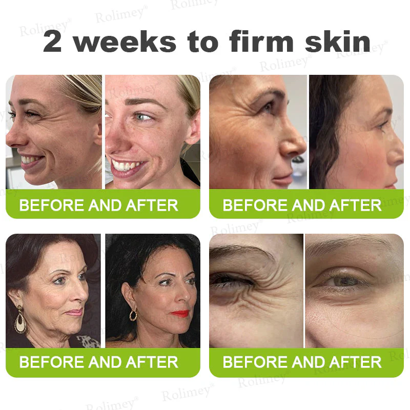 ✨👨‍⚕️ Doctor-Grade Wrinkle Lift You Can See | Botox & Retinol Wrinkle-Lift Cream | 💯 Full Refund If No Results | 🔥 Last Day 70% OFF