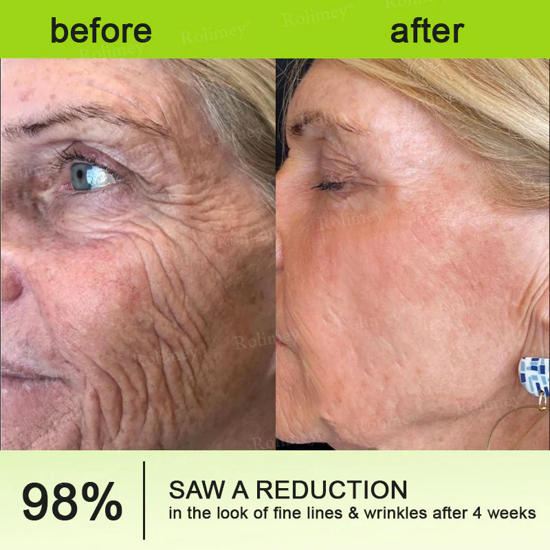 ✨👨‍⚕️ Doctor-Grade Wrinkle Lift You Can See | Botox & Retinol Wrinkle-Lift Cream | 💯 Full Refund If No Results | 🔥 Last Day 70% OFF